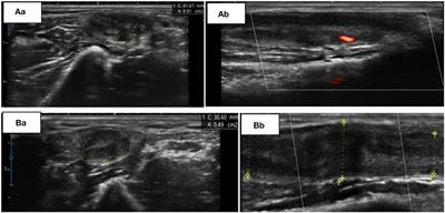 Case report: Injected corticosteroids for treating leprosy isolated neuritis